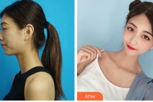 解放軍105醫(yī)院整形美容中心黃進(jìn)軍整形價(jià)格表附鼻部綜合案例展示