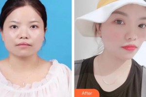 中國人民解放軍第100醫(yī)院整形美容中心孫守縣整形價(jià)格表附埋線提升案例展示