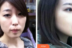 中國人民解放軍第100醫(yī)院整形美容中心樊彥奇整形價(jià)格表附埋線提升案例展示