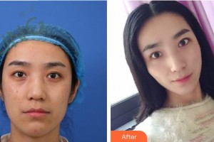 中國人民解放軍第100醫(yī)院整形美容中心李欣整形價(jià)格表附埋線提升案例展示