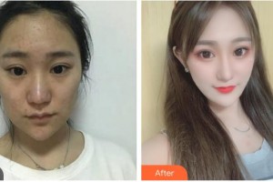 中國人民解放軍第四二一疤痕修復(fù)中心王廣浩整形價(jià)格表附埋線提升案例展示