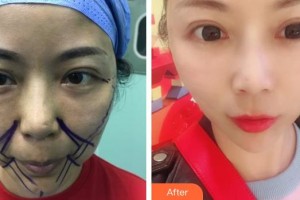 中國人民解放軍第455疤痕調(diào)節(jié)中心鐘曉珊整形價(jià)格表附埋線提升案例展示