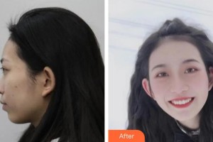 中國人民解放軍455胎記診療中心孫曉迪整形價(jià)格表附埋線提升案例展示