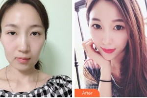 中國人民解放軍第100醫(yī)院整形美容中心陳舒整形價(jià)格表附熱瑪吉案例展示