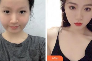 中國人民解放軍第100醫(yī)院整形美容中心汪松林整形價(jià)格表附埋線提升案例展示