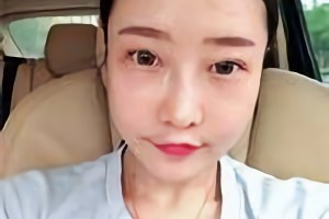 華西口腔醫(yī)院李運(yùn)峰磨骨手術(shù)價(jià)格貴嗎？附價(jià)格表和案例