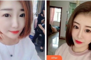 第四軍醫(yī)大學(xué)唐都醫(yī)院整形激光美容中心李學(xué)擁整形價(jià)格表附肋軟骨隆鼻案例展示