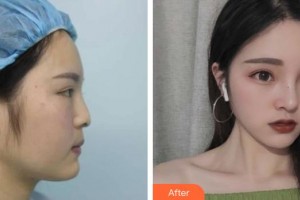 第四軍醫(yī)大學(xué)唐都醫(yī)院整形激光美容中心李靖整形價(jià)格表附鼻部綜合案例展示