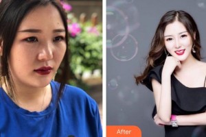 第四軍醫(yī)大學(xué)唐都醫(yī)院整形激光美容中心曹彥整形價(jià)格表附耳軟骨復(fù)合隆鼻案例展示