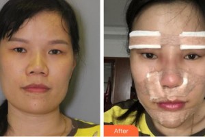 第四軍醫(yī)大學(xué)唐都醫(yī)院整形激光美容中心劉綱整形價(jià)格表附鼻部綜合案例展示