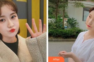 第四軍醫(yī)大學(xué)唐都醫(yī)院整形激光美容中心呂小星整形價(jià)格表附墊鼻基底案例展示