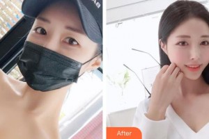 中國醫(yī)學(xué)科學(xué)院整形外科醫(yī)院張智勇整形價(jià)格表附清潔祛痘案例展示