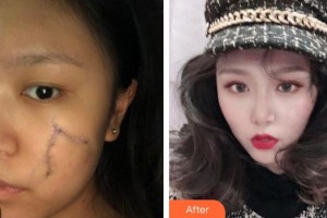 中國醫(yī)學(xué)科學(xué)院整形外科醫(yī)院滕利整形價(jià)格表附激光祛疤案例展示