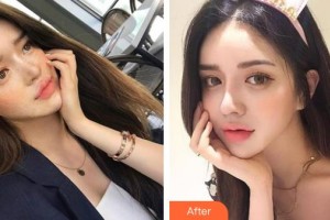 中國醫(yī)學(xué)科學(xué)院整形外科醫(yī)院范飛整形價(jià)格表附鐳射凈膚案例展示