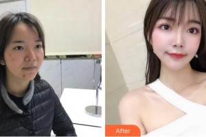 中國醫(yī)學(xué)科學(xué)院整形外科醫(yī)院馬桂娥整形價(jià)格表附紅藍(lán)光祛痘案例展示