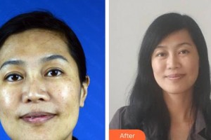 中國醫(yī)學(xué)科學(xué)院整形外科醫(yī)院楊斌整形價(jià)格表附光子嫩膚案例展示