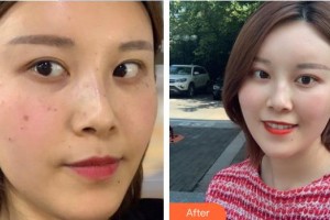 中國醫(yī)學(xué)科學(xué)院整形外科醫(yī)院孫曉梅整形價(jià)格表附彩光嫩膚案例展示