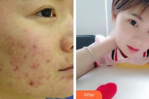 中國(guó)醫(yī)學(xué)科學(xué)院整形外科醫(yī)院劉立強(qiáng)、副教授整形價(jià)格表附去痘印痘坑案例展示