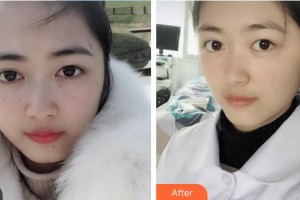 中國(guó)醫(yī)學(xué)科學(xué)院整形外科醫(yī)院何樂人整形價(jià)格表附祛斑祛痣案例展示