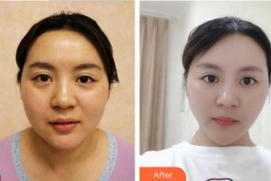 中國(guó)醫(yī)學(xué)科學(xué)院整形外科醫(yī)院潘博整形價(jià)格表附清潔祛痘案例展示