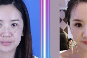 中國(guó)醫(yī)學(xué)科學(xué)院整形外科醫(yī)院徐家杰副教授整形價(jià)格表附去痘印痘坑案例展示