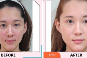 中國(guó)醫(yī)學(xué)科學(xué)院整形外科醫(yī)院牛峰整形價(jià)格表附根管調(diào)節(jié)案例展示