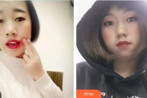 中國(guó)航天科工集團(tuán)731醫(yī)院整形美容科陳志剛整形價(jià)格表附根管調(diào)節(jié)案例展示