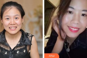 中國(guó)醫(yī)科大學(xué)航空總醫(yī)院拇外翻矯正科宋春蘭整形價(jià)格表附自鎖托槽矯正案例展示