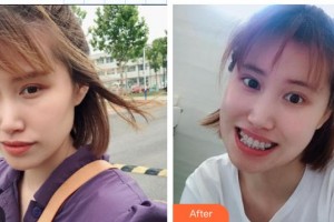 中國(guó)醫(yī)科大學(xué)航空總醫(yī)院皮膚激光整形美容中心于紅敏整形價(jià)格表附金屬托槽矯正案例展示