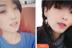 中國(guó)醫(yī)科大學(xué)航空總醫(yī)院疤痕修復(fù)科陳業(yè)忠整形價(jià)格表附金屬托槽矯正案例展示