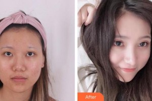 中國(guó)科大眼科醫(yī)院劉才遠(yuǎn)整形價(jià)格表附切開雙眼皮案例展示