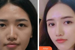 中國(guó)科大眼科醫(yī)院陳鶯整形價(jià)格表附開內(nèi)眼角案例展示