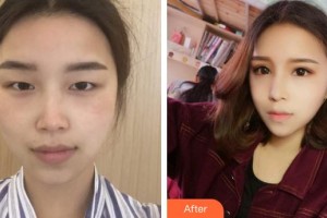 中國(guó)醫(yī)科大學(xué)附屬第一醫(yī)院整形外科徐楠整形價(jià)格表附眼部綜合案例展示