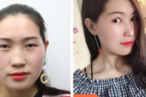 中國(guó)醫(yī)科大學(xué)附屬第一醫(yī)院整形外科佟爽整形價(jià)格表附切開雙眼皮案例展示