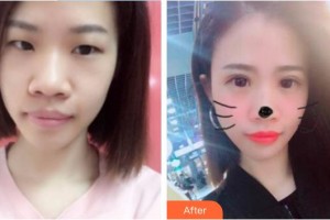 中國(guó)醫(yī)科大學(xué)附屬第一醫(yī)院整形外科王玉新整形價(jià)格表附切開雙眼皮案例展示