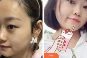 福清天寶美容醫(yī)院孟祥重整形價(jià)格表附膨體隆鼻案例展示