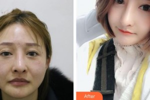 福清天寶美容醫(yī)院林芳整形價(jià)格表附鼻部綜合案例展示
