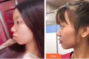 福清天寶美容醫(yī)院舒小芳整形價(jià)格表附金屬托槽矯正案例展示