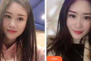 象山華美整形美容醫(yī)院許哲整形價(jià)格表附冷光美白案例展示