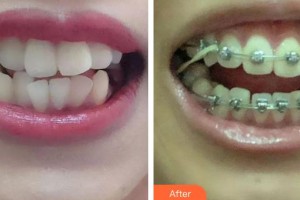 象山華美整形美容醫(yī)院沉載善整形價(jià)格表附金屬托槽矯正案例展示