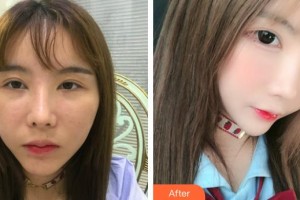 象山愛爾眼科醫(yī)院張美萍整形價(jià)格表附下瞼整形案例展示