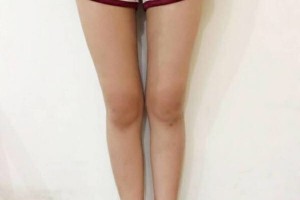 昆明醫(yī)學(xué)院整形美容中心如何？附吸脂瘦腿附果圖及價格一覽