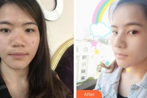 郴州維納斯醫(yī)療美容醫(yī)院汪海濱整形價(jià)格表附耳軟骨復(fù)合隆鼻案例展示