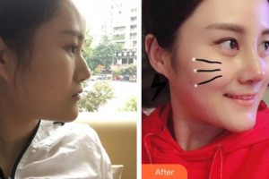 郴州韓雅醫(yī)療美容醫(yī)院劉萍高整形價(jià)格表附鼻部綜合案例展示