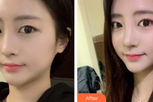 郴州韓雅醫(yī)療美容醫(yī)院明經(jīng)發(fā)整形價(jià)格表附鼻部綜合案例展示