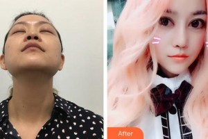 郴州韓雅醫(yī)療美容醫(yī)院楊嬌整形價(jià)格表附鼻部綜合案例展示