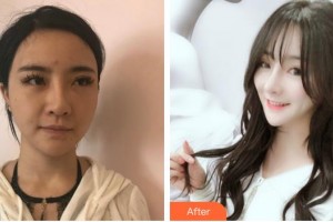 郴州市第一人民醫(yī)院整形美容科梁志為整形價(jià)格表附鼻部綜合案例展示