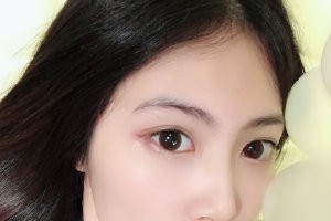 西京醫(yī)院整形外科怎么樣？隆鼻手術(shù)附果圖