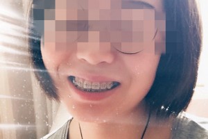南京市口腔醫(yī)院牙齒矯正果？術(shù)后經(jīng)驗分享