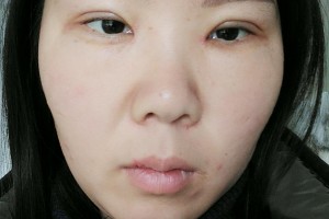 河北醫(yī)科大學(xué)第二醫(yī)院整形美容科雙眼皮手術(shù)哪個醫(yī)生好附案例